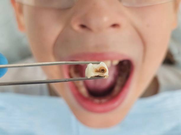 Best Emergency Gum Treatment in St Elmo, IL